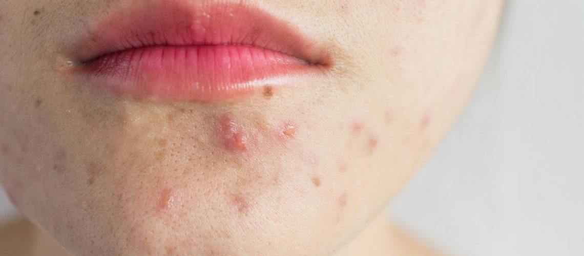 Papules : faut-il les percer, les ignorer ou les traiter ?